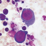 Ghi nhận ca viêm não cấp hiếm gặp do Parvovirus B19 ở Việt Nam